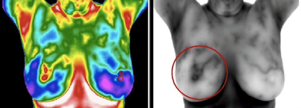 Breast thermography for breast health