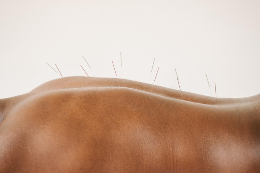 Pain Relief Acupuncture in NYC